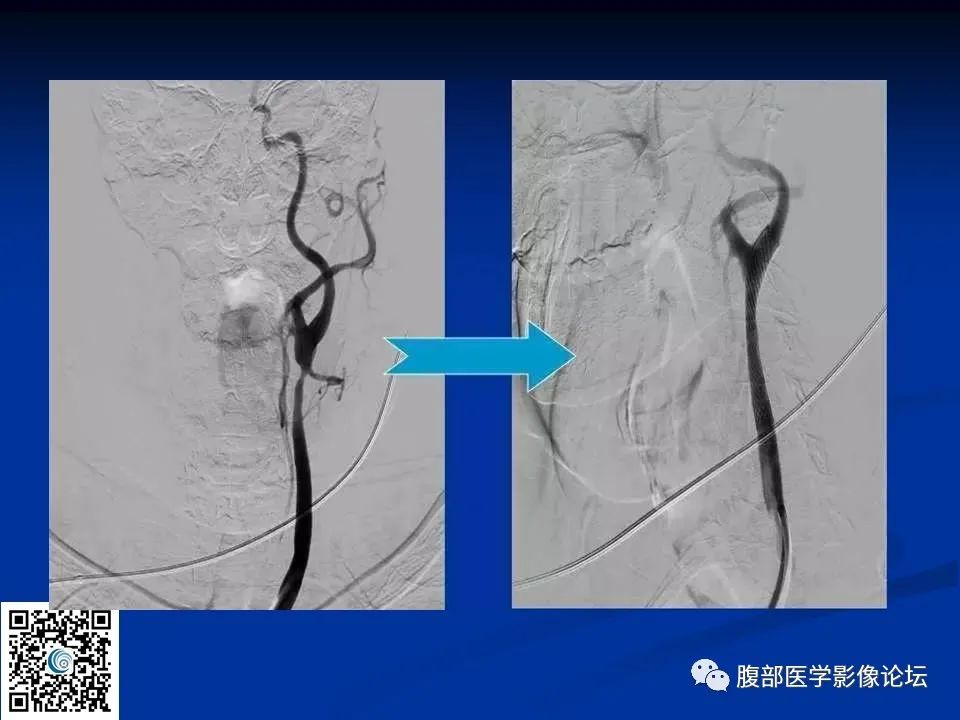 影像PPT - 【PPT】早期脑梗死MR诊断的一点体会-91