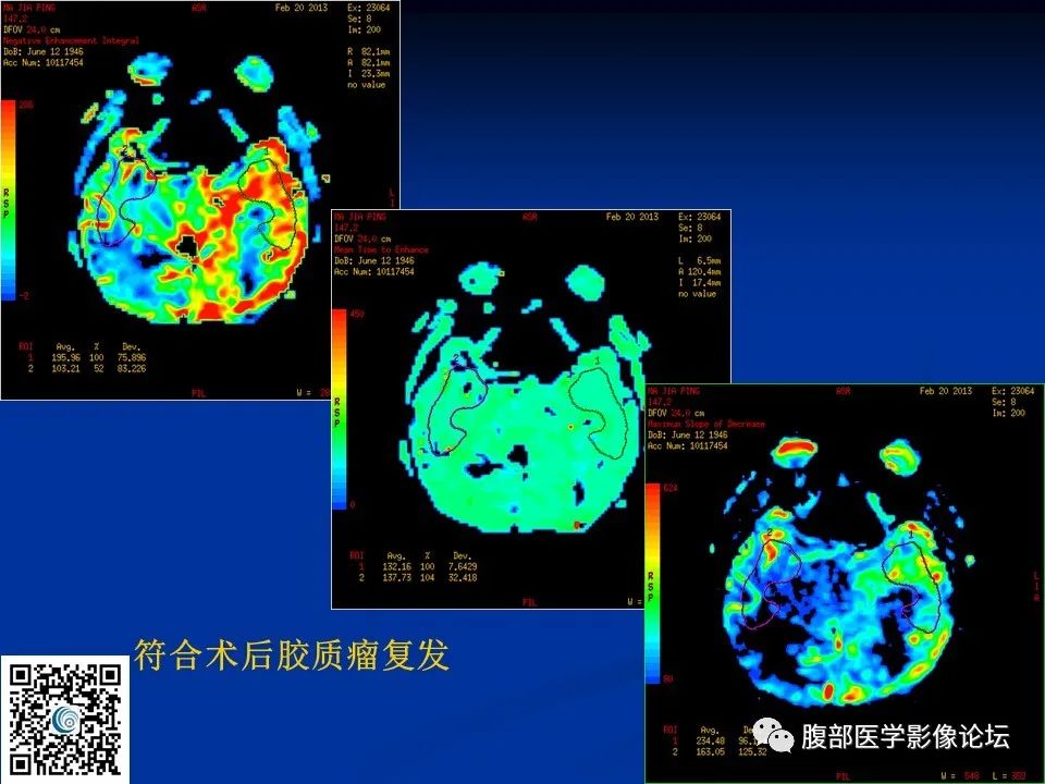 影像PPT - 【PPT】早期脑梗死MR诊断的一点体会-93