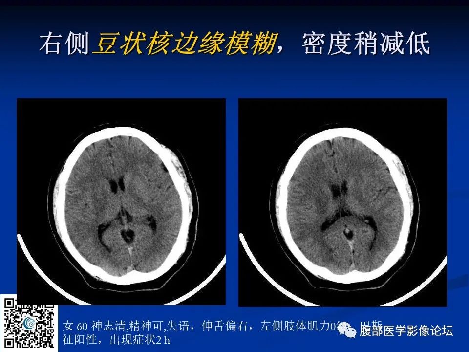 影像PPT - 【PPT】早期脑梗死MR诊断的一点体会-97