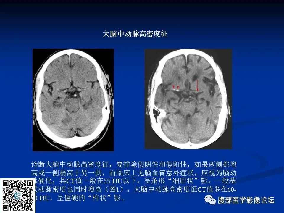 影像PPT - 【PPT】早期脑梗死MR诊断的一点体会-96