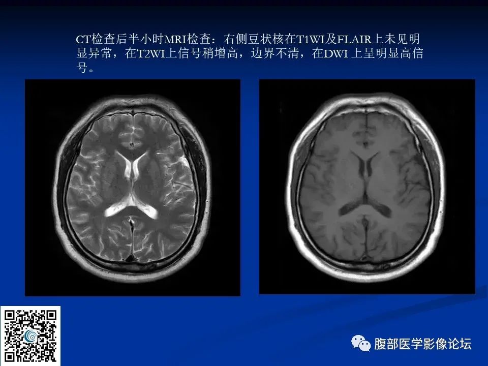 影像PPT - 【PPT】早期脑梗死MR诊断的一点体会-98