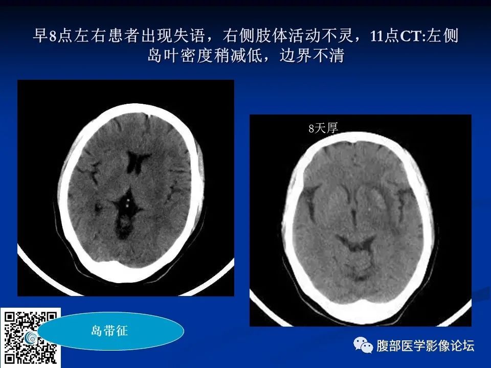 影像PPT - 【PPT】早期脑梗死MR诊断的一点体会-100