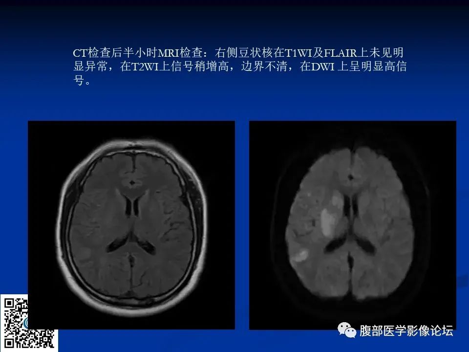 影像PPT - 【PPT】早期脑梗死MR诊断的一点体会-99