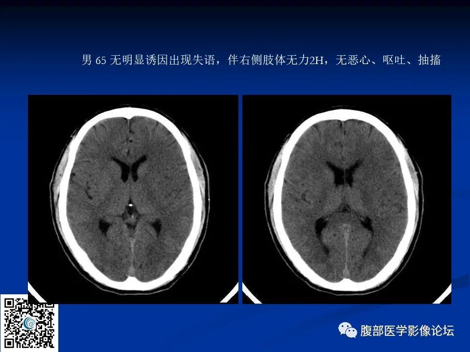 影像PPT - 【PPT】早期脑梗死MR诊断的一点体会-103