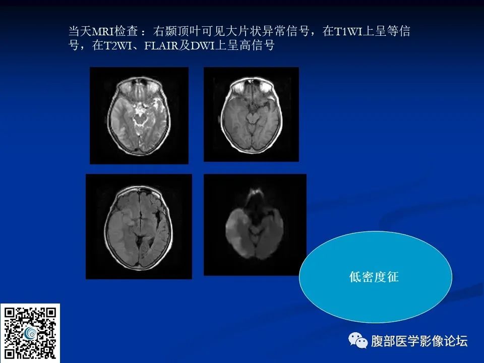 影像PPT - 【PPT】早期脑梗死MR诊断的一点体会-102