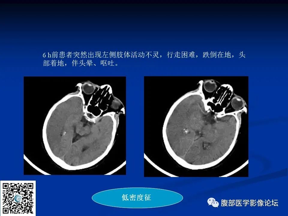 影像PPT - 【PPT】早期脑梗死MR诊断的一点体会-101