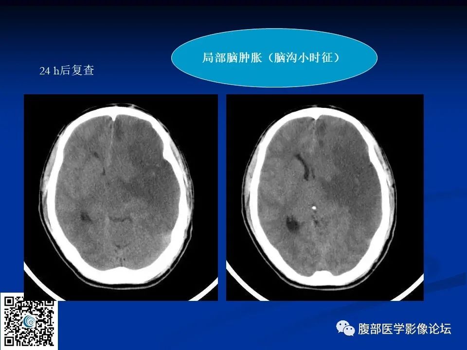 影像PPT - 【PPT】早期脑梗死MR诊断的一点体会-104