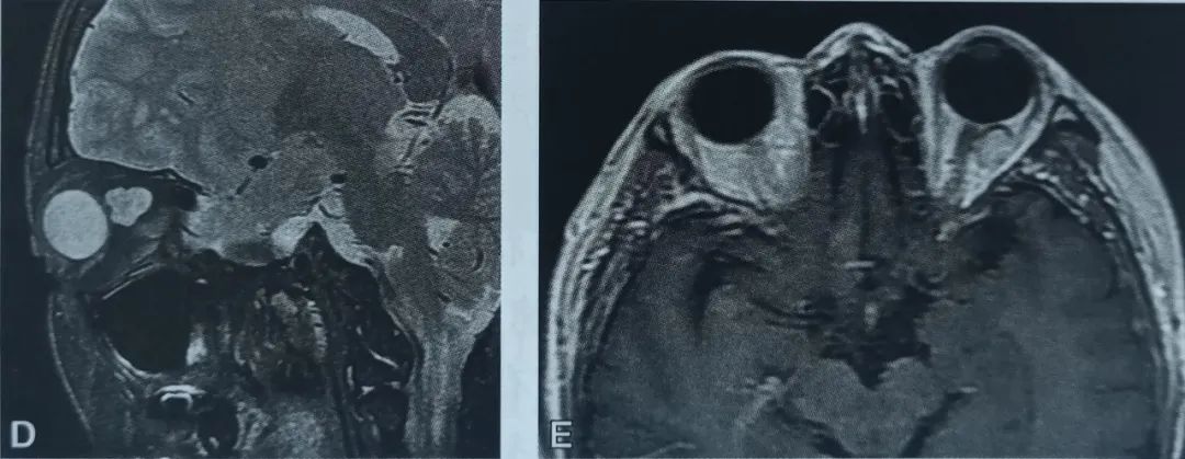 影像PPT - 眼眶海绵状血管瘤影像诊断-3 影像PPT - 眼眶海绵状血管瘤影像诊断-3