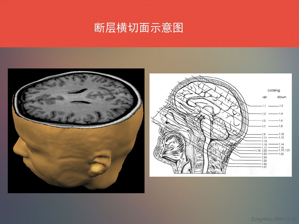 影像PPT - 脑功能区及解剖影像-2