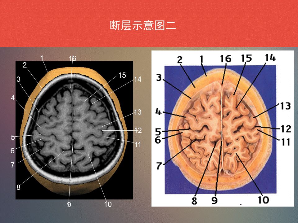 影像PPT - 脑功能区及解剖影像-5