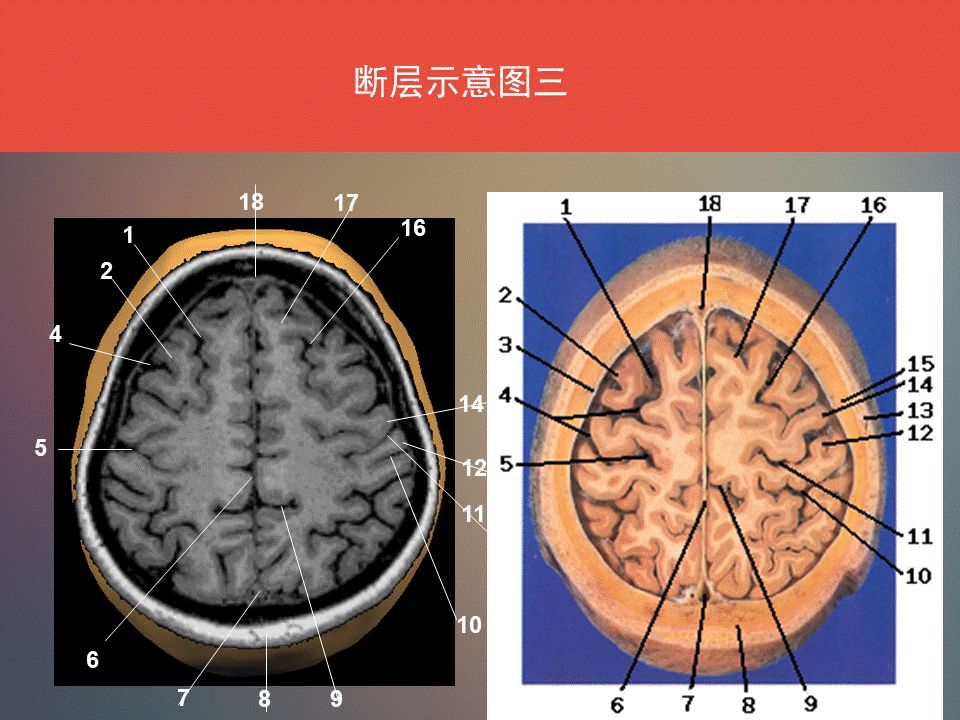 影像PPT - 脑功能区及解剖影像-8