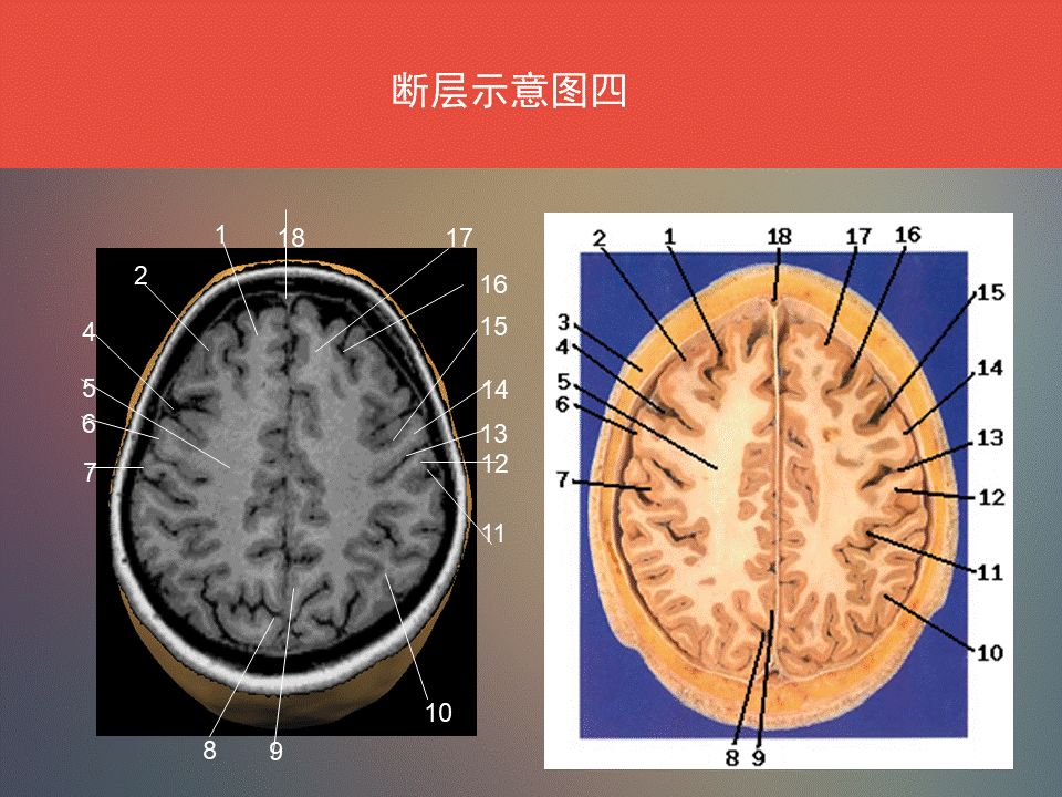 影像PPT - 脑功能区及解剖影像-11