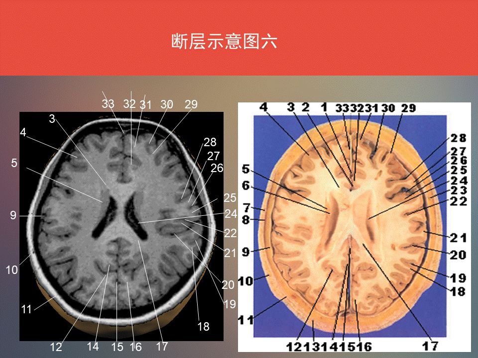 影像PPT - 脑功能区及解剖影像-16