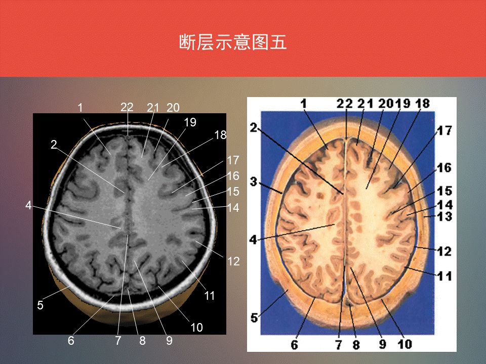 影像PPT - 脑功能区及解剖影像-13