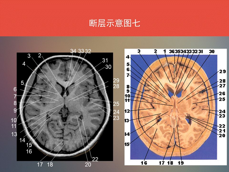 影像PPT - 脑功能区及解剖影像-19