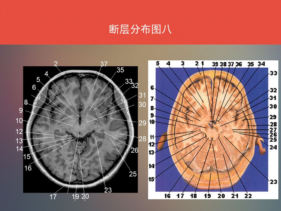 影像PPT - 脑功能区及解剖影像-22
