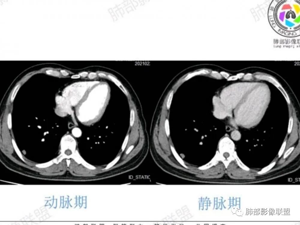 影像PPT - 【每日晨读】宽基底的胸膜下孤立结节你怎样决断?-3 影像PPT - 【每日晨读】宽基底的胸膜下孤立结节你怎样决断?-3