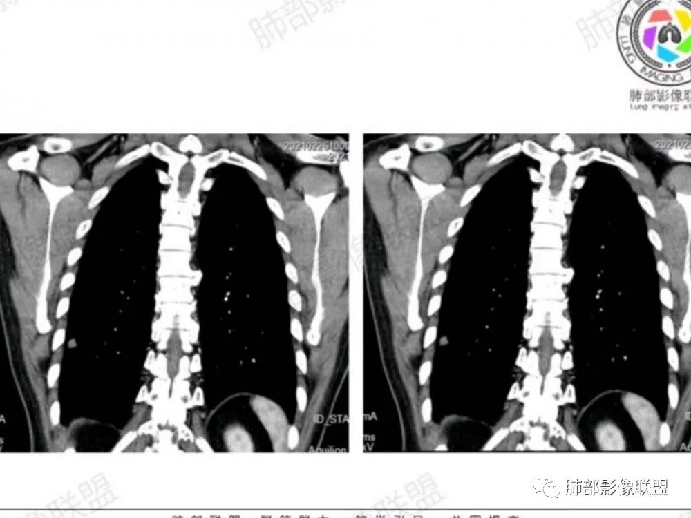 影像PPT - 【每日晨读】宽基底的胸膜下孤立结节你怎样决断?-6 影像PPT - 【每日晨读】宽基底的胸膜下孤立结节你怎样决断?-6