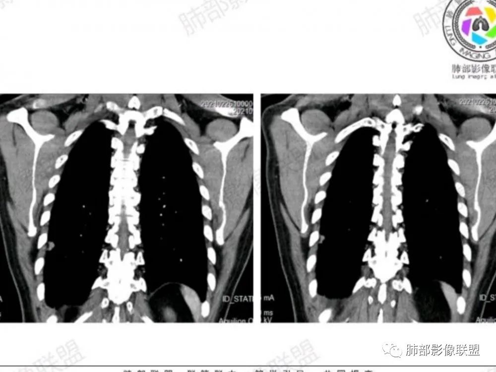 影像PPT - 【每日晨读】宽基底的胸膜下孤立结节你怎样决断?-5 影像PPT - 【每日晨读】宽基底的胸膜下孤立结节你怎样决断?-5