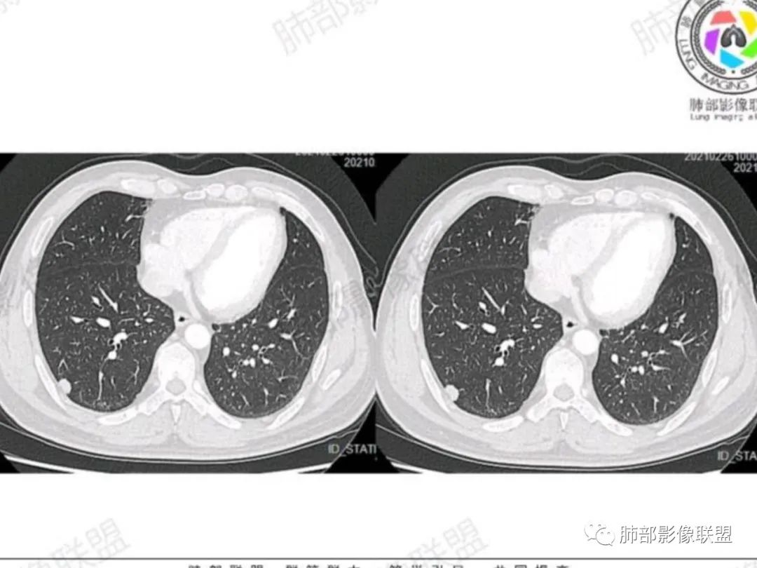 影像PPT - 【每日晨读】宽基底的胸膜下孤立结节你怎样决断?-14 影像PPT - 【每日晨读】宽基底的胸膜下孤立结节你怎样决断?-14
