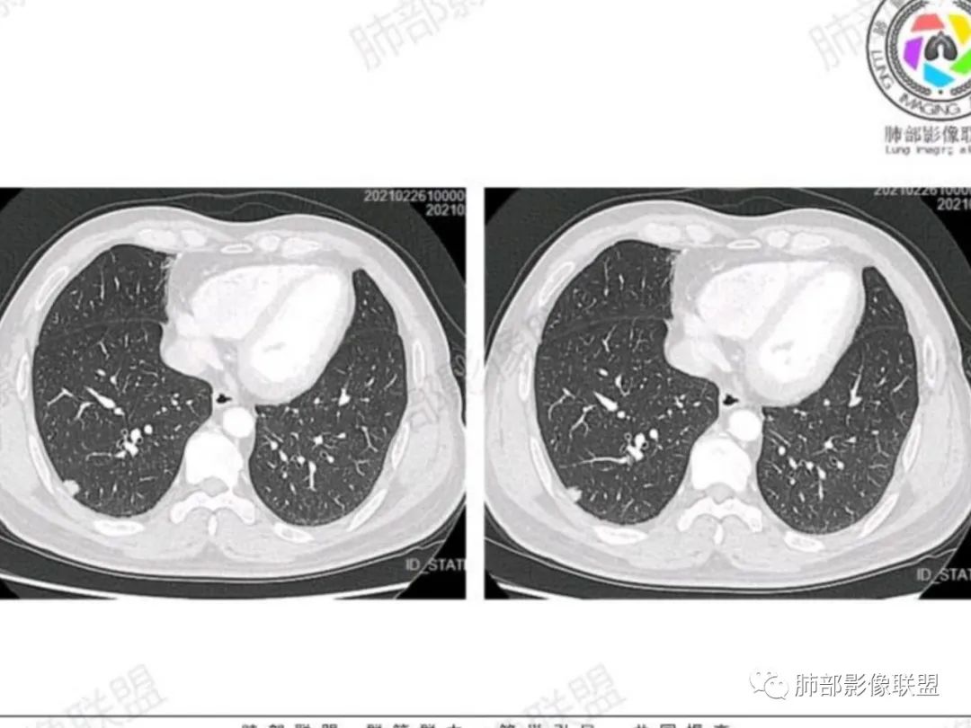 影像PPT - 【每日晨读】宽基底的胸膜下孤立结节你怎样决断?-16 影像PPT - 【每日晨读】宽基底的胸膜下孤立结节你怎样决断?-16