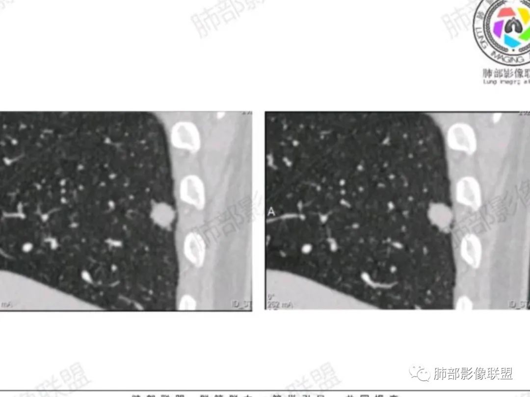 影像PPT - 【每日晨读】宽基底的胸膜下孤立结节你怎样决断?-17 影像PPT - 【每日晨读】宽基底的胸膜下孤立结节你怎样决断?-17