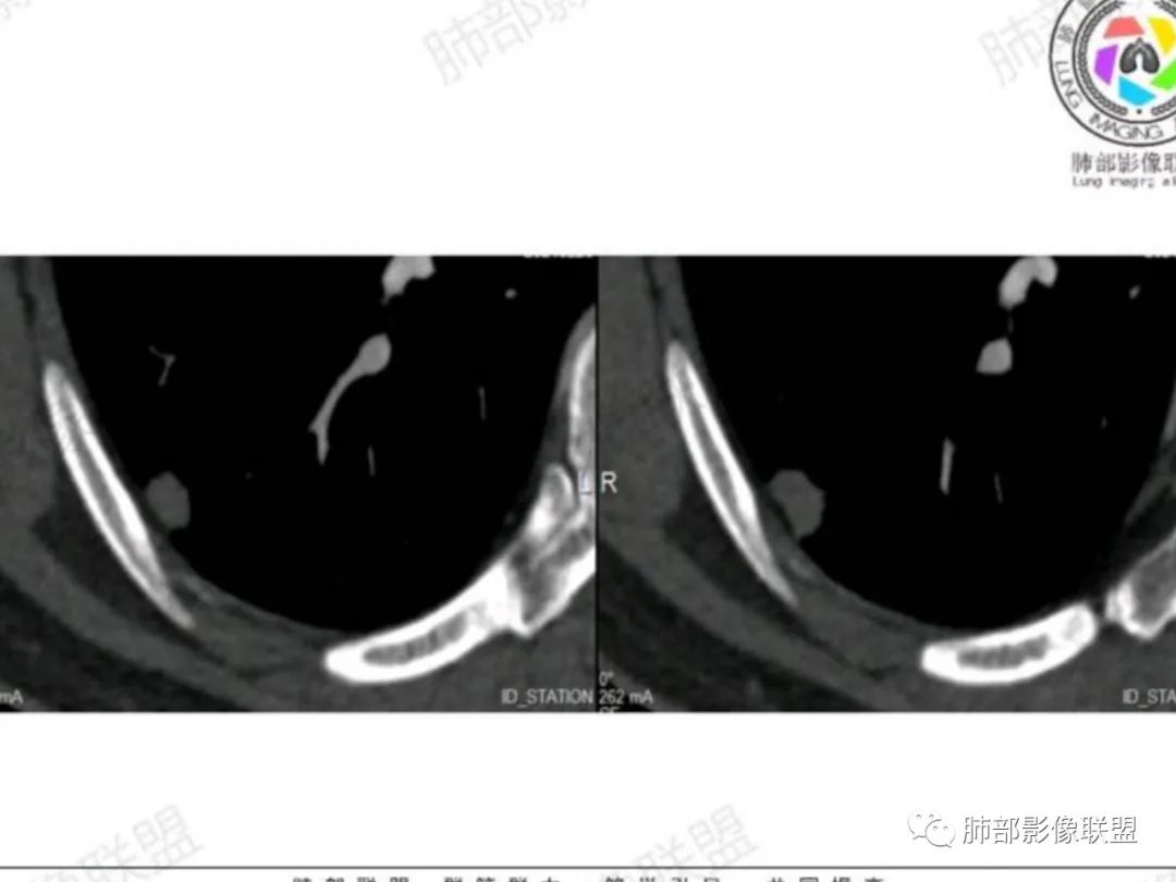 影像PPT - 【每日晨读】宽基底的胸膜下孤立结节你怎样决断?-18 影像PPT - 【每日晨读】宽基底的胸膜下孤立结节你怎样决断?-18