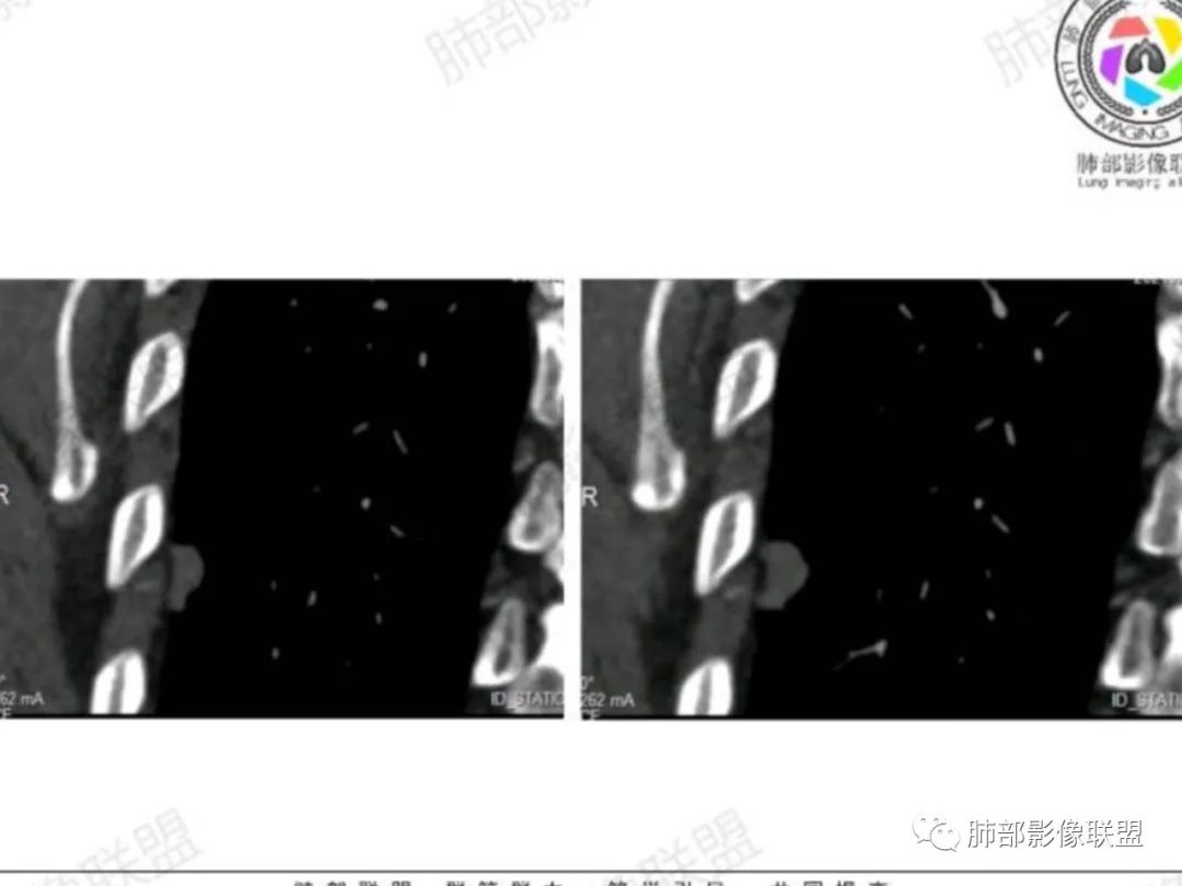 影像PPT - 【每日晨读】宽基底的胸膜下孤立结节你怎样决断?-20 影像PPT - 【每日晨读】宽基底的胸膜下孤立结节你怎样决断?-20