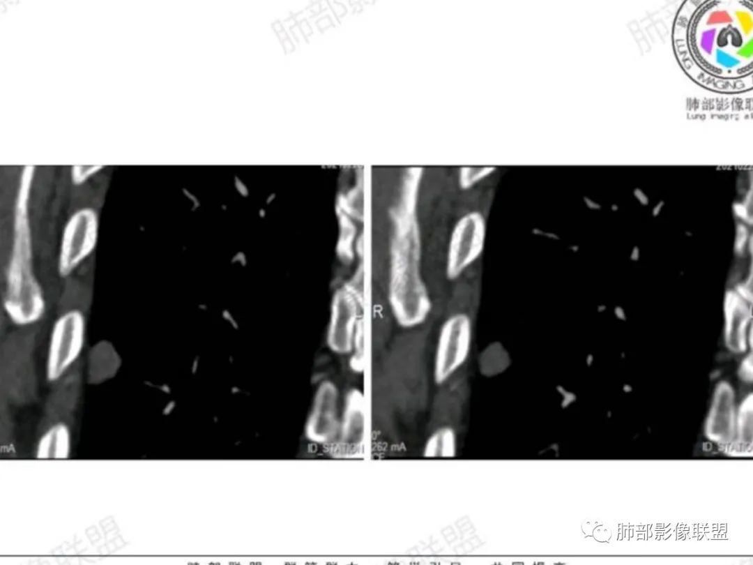 影像PPT - 【每日晨读】宽基底的胸膜下孤立结节你怎样决断?-21 影像PPT - 【每日晨读】宽基底的胸膜下孤立结节你怎样决断?-21
