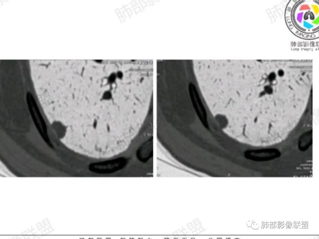 影像PPT - 【每日晨读】宽基底的胸膜下孤立结节你怎样决断?-24 影像PPT - 【每日晨读】宽基底的胸膜下孤立结节你怎样决断?-24