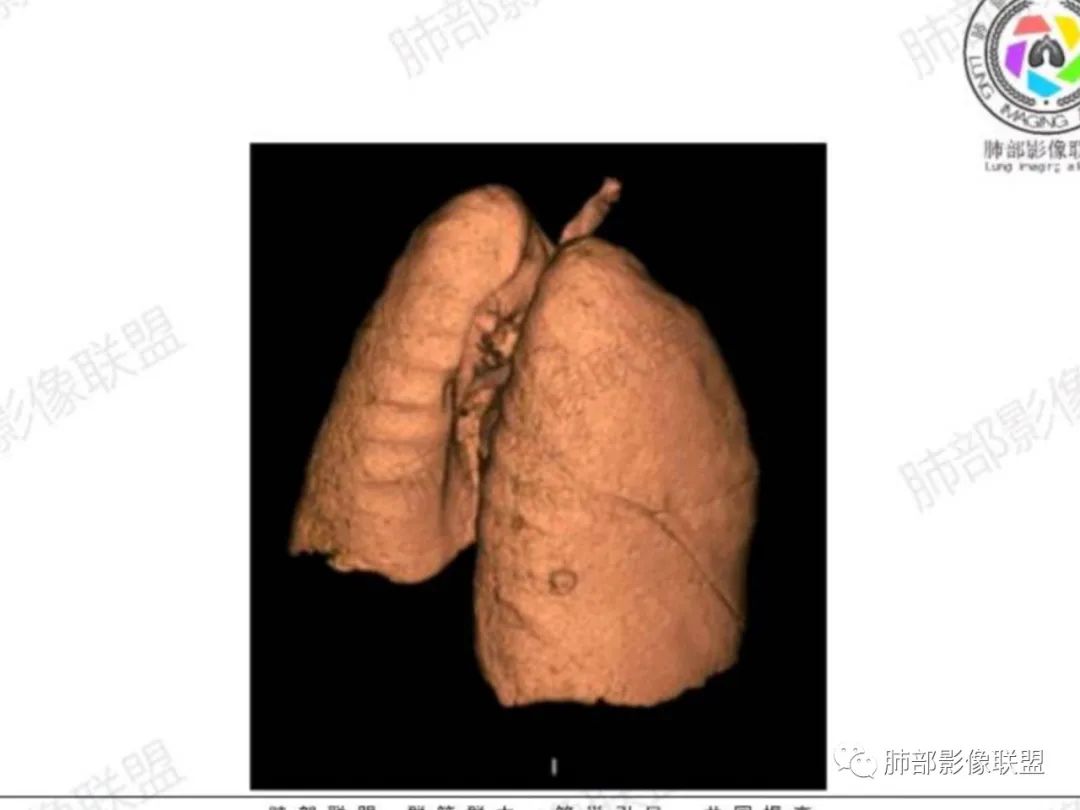 影像PPT - 【每日晨读】宽基底的胸膜下孤立结节你怎样决断?-27 影像PPT - 【每日晨读】宽基底的胸膜下孤立结节你怎样决断?-27