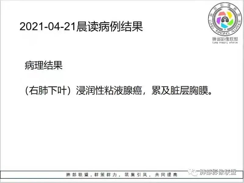 影像PPT - 【每日晨读】宽基底的胸膜下孤立结节你怎样决断?-29 影像PPT - 【每日晨读】宽基底的胸膜下孤立结节你怎样决断?-29