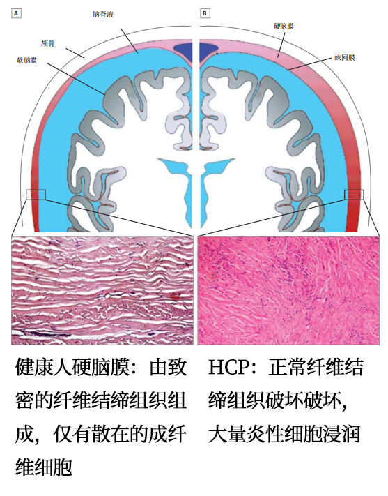 影像PPT - 肥厚性硬脑膜炎的前世今生-7 影像PPT - 肥厚性硬脑膜炎的前世今生-7