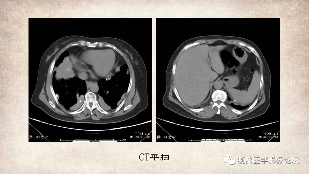 影像PPT - 【病例】肝脏硬化性血管瘤1例影像表现-3