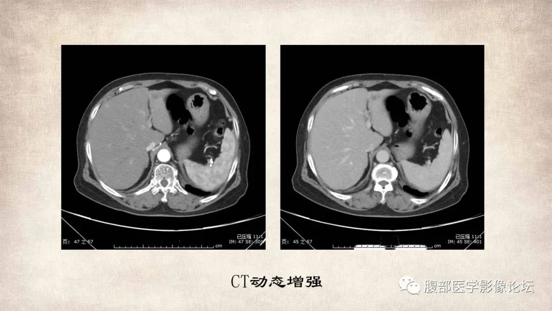 影像PPT - 【病例】肝脏硬化性血管瘤1例影像表现-4