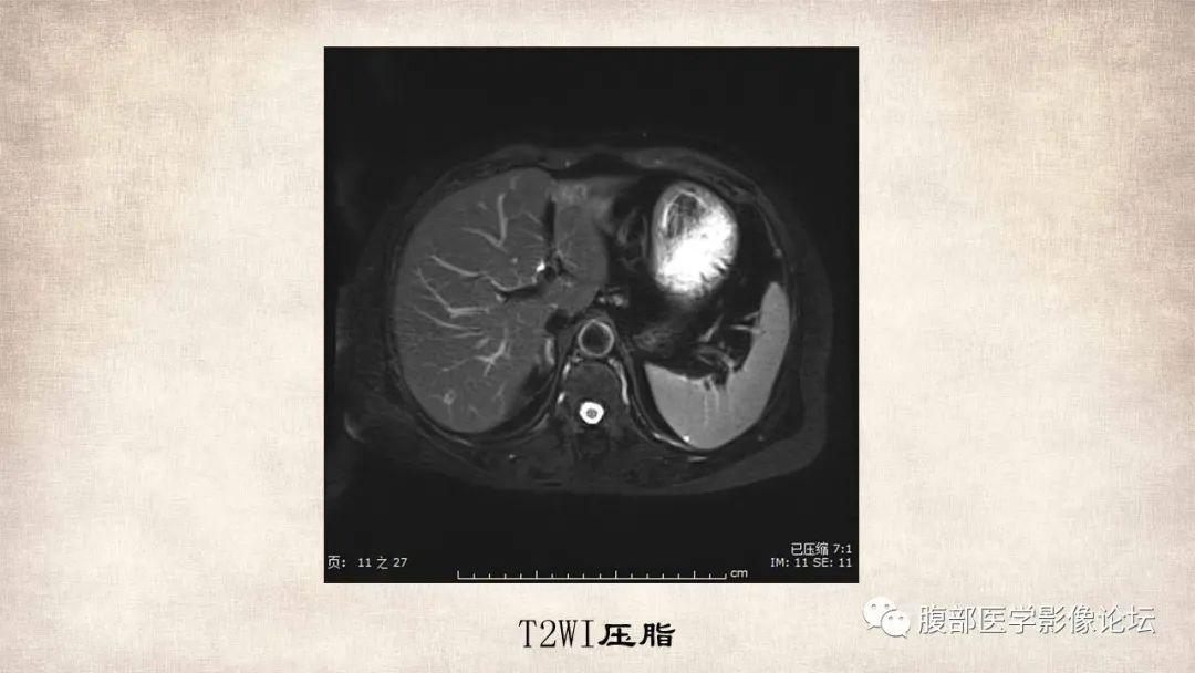 影像PPT - 【病例】肝脏硬化性血管瘤1例影像表现-6