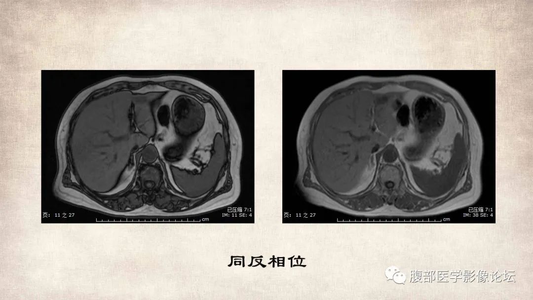 影像PPT - 【病例】肝脏硬化性血管瘤1例影像表现-5