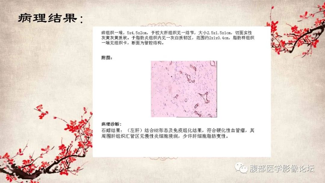 影像PPT - 【病例】肝脏硬化性血管瘤1例影像表现-15