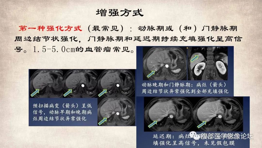 影像PPT - 【病例】肝脏硬化性血管瘤1例影像表现-20
