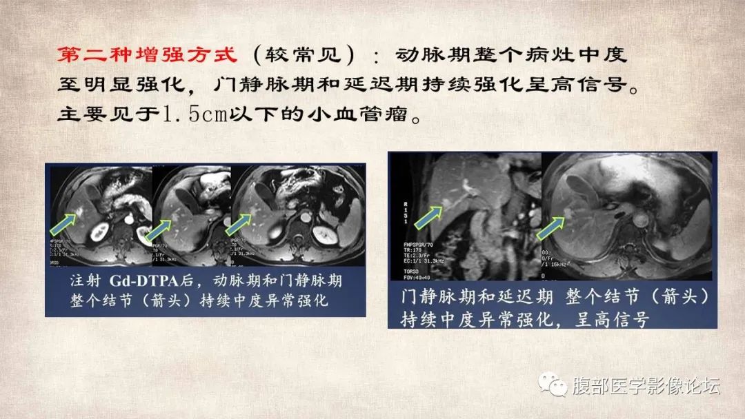 影像PPT - 【病例】肝脏硬化性血管瘤1例影像表现-21