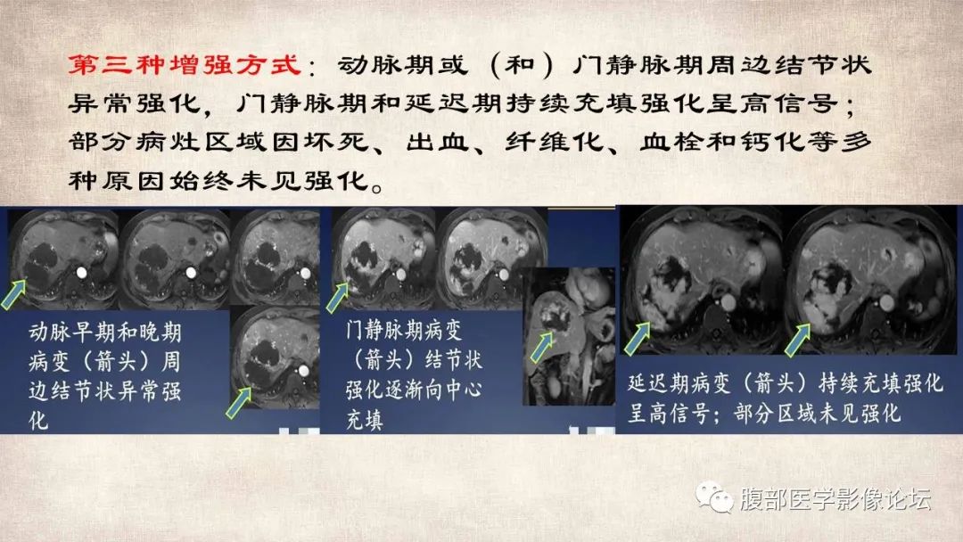影像PPT - 【病例】肝脏硬化性血管瘤1例影像表现-22