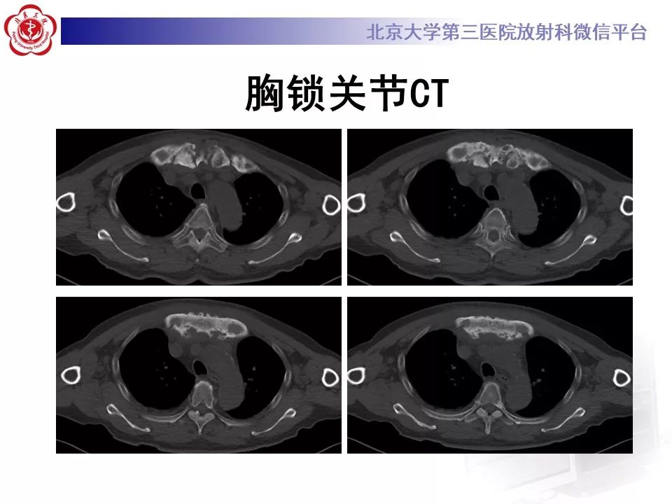 影像PPT - 【PPT】SAPHO综合征-3
