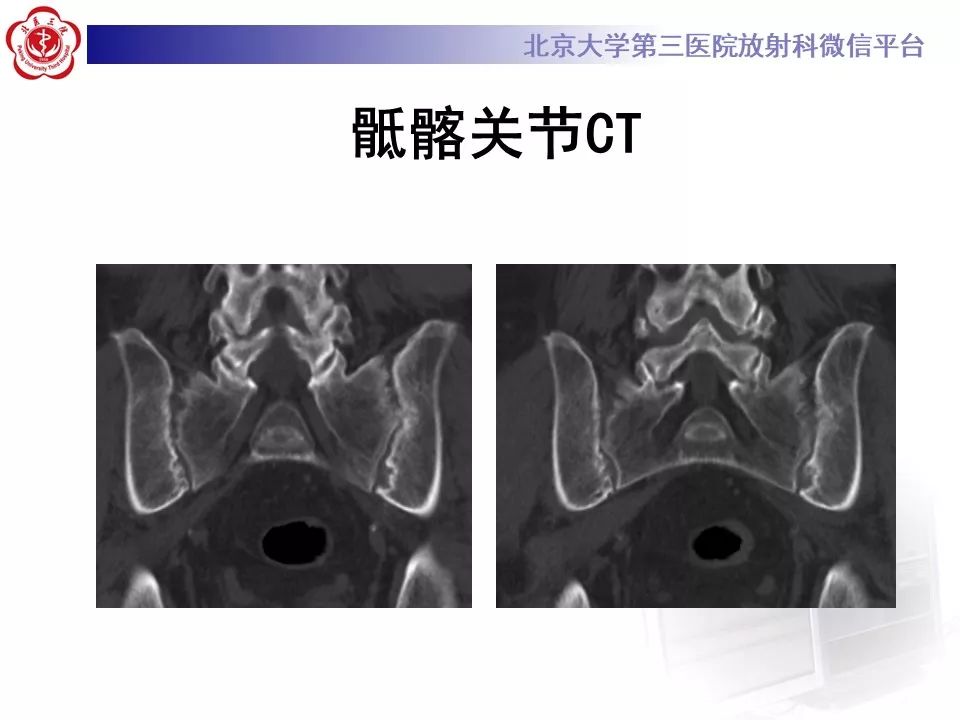影像PPT - 【PPT】SAPHO综合征-6
