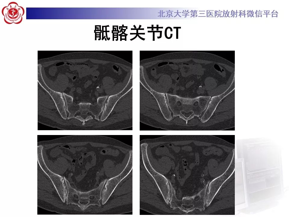 影像PPT - 【PPT】SAPHO综合征-5