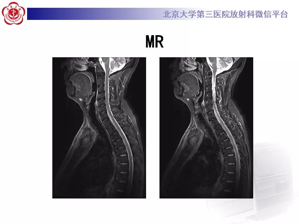影像PPT - 【PPT】SAPHO综合征-7