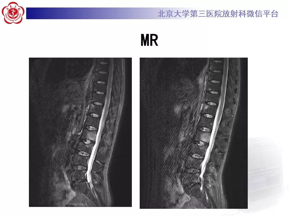 影像PPT - 【PPT】SAPHO综合征-8