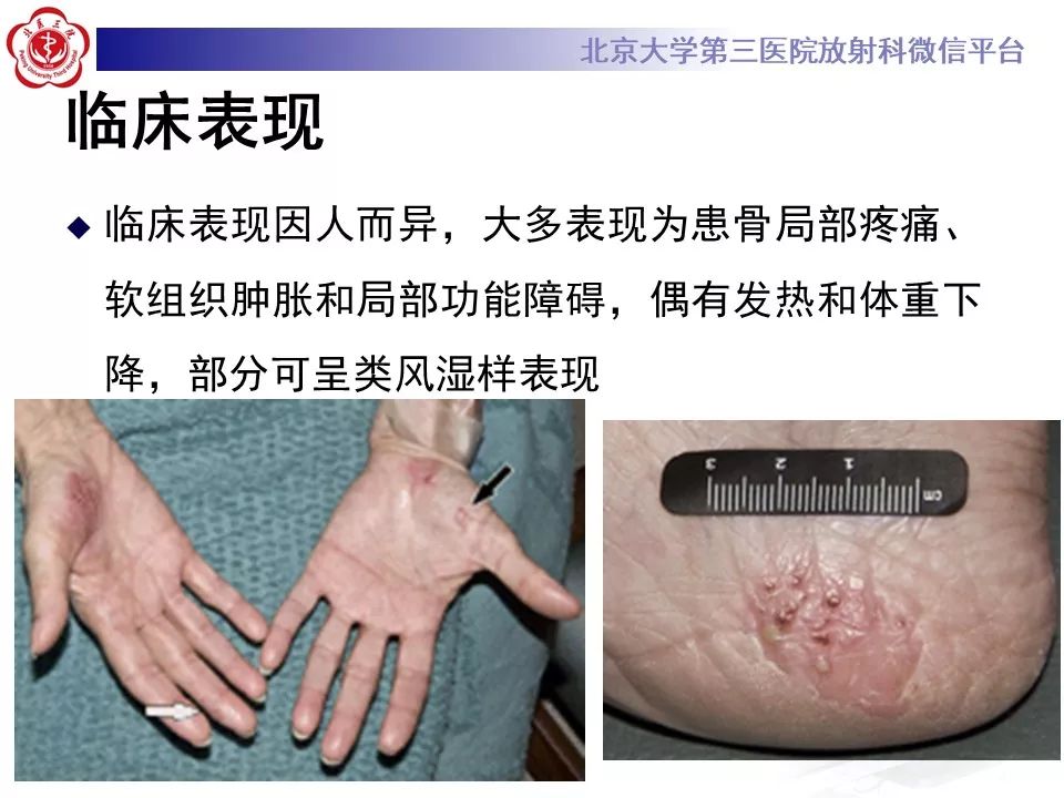 影像PPT - 【PPT】SAPHO综合征-15