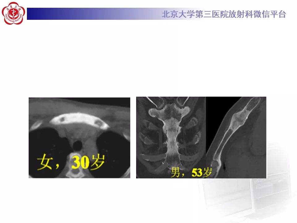 影像PPT - 【PPT】SAPHO综合征-22