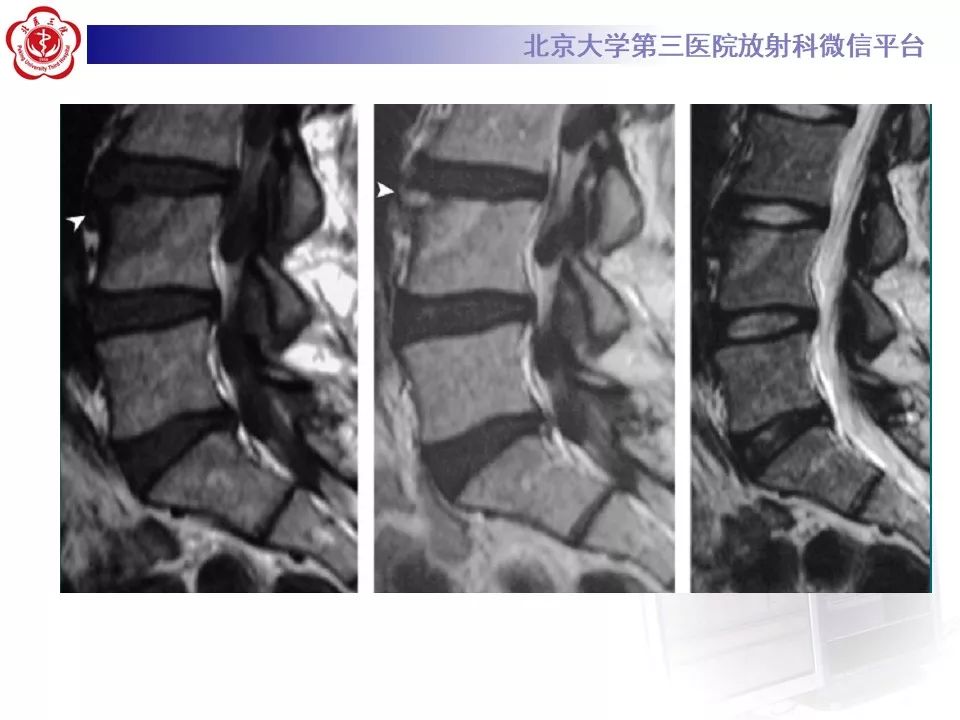 影像PPT - 【PPT】SAPHO综合征-24
