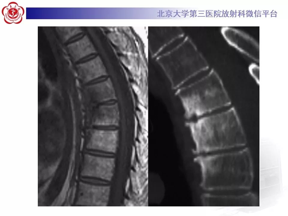 影像PPT - 【PPT】SAPHO综合征-23